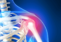 Illustration of shoulder pain in skeleton
