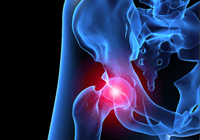 X-ray of hip joint with pain